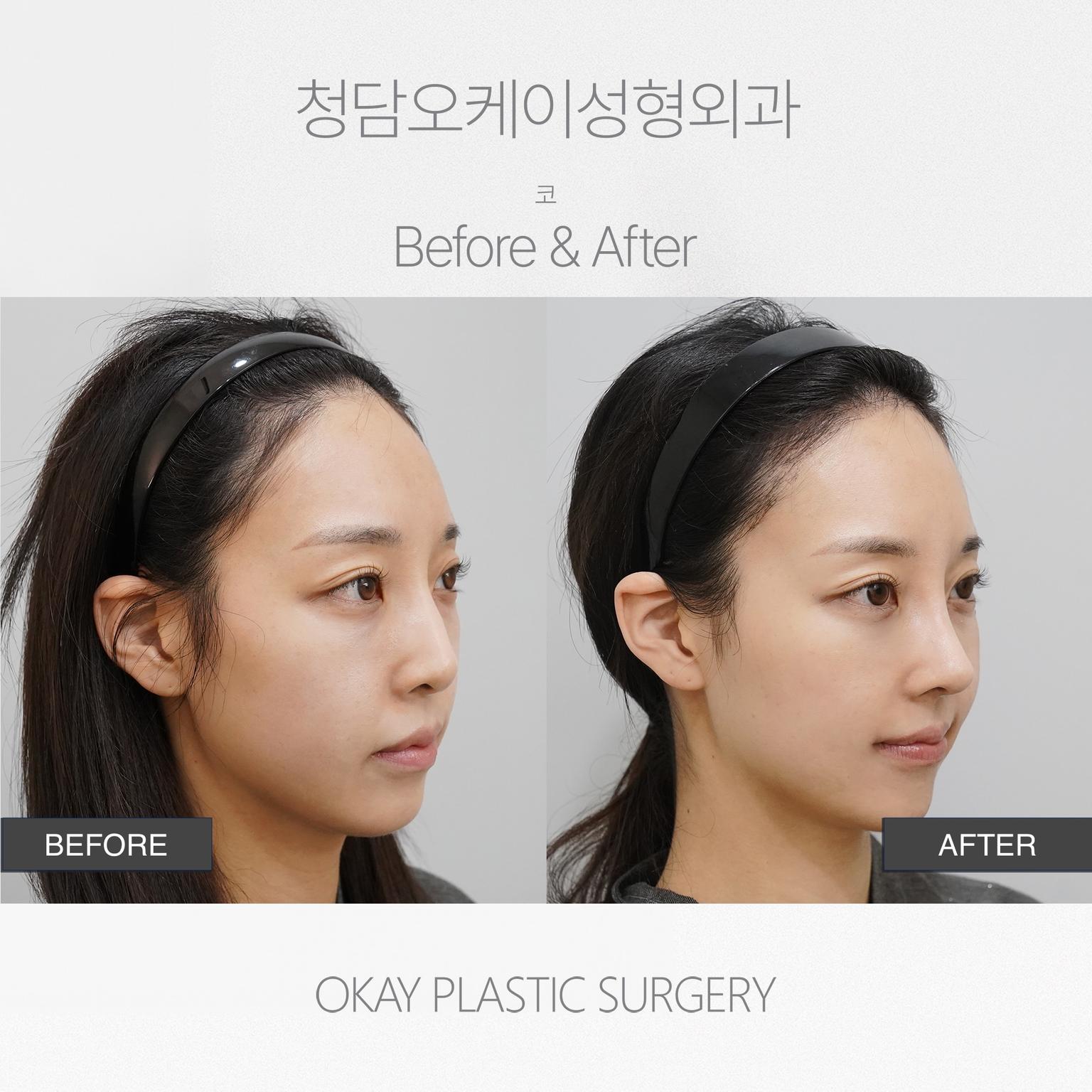 Okay Plastic Surgery Clinic before and after image