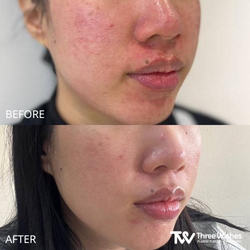 Acne Treatment