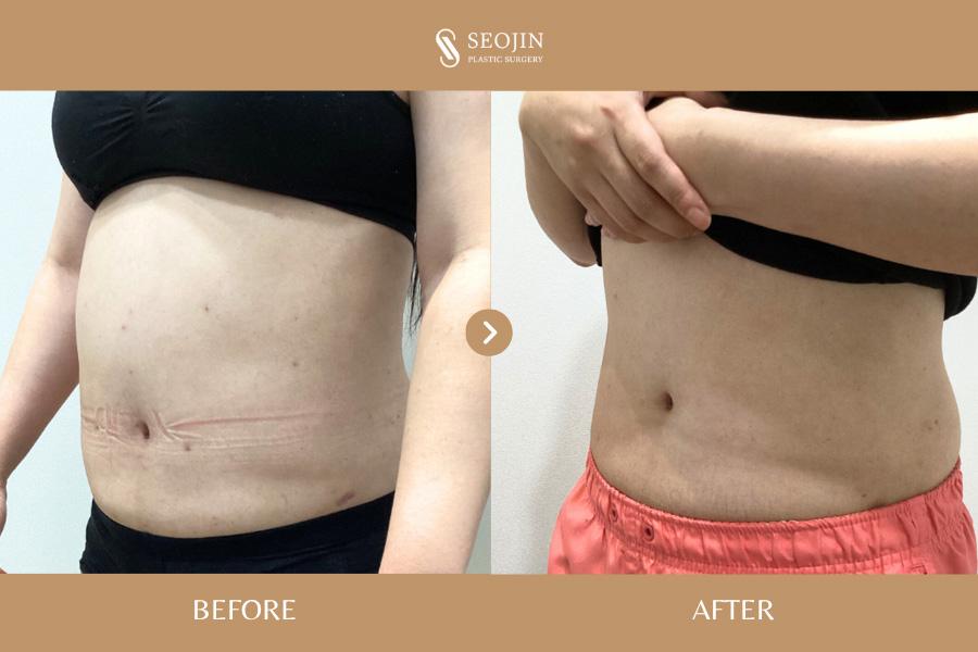Seojin Plastic Surgery Clinic before and after image