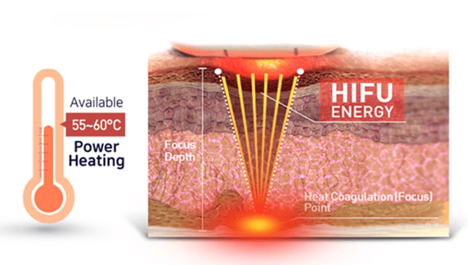 Vaginal Tightening Laser