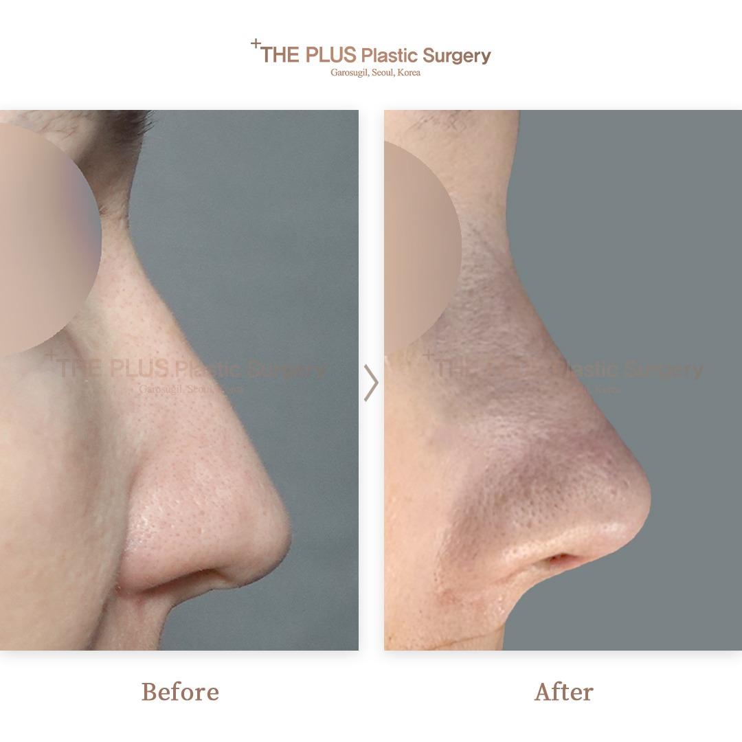 2nd Revision Rhinoplasty & Nose Osteotomy & Septoplasty & Rhinitis Surgery