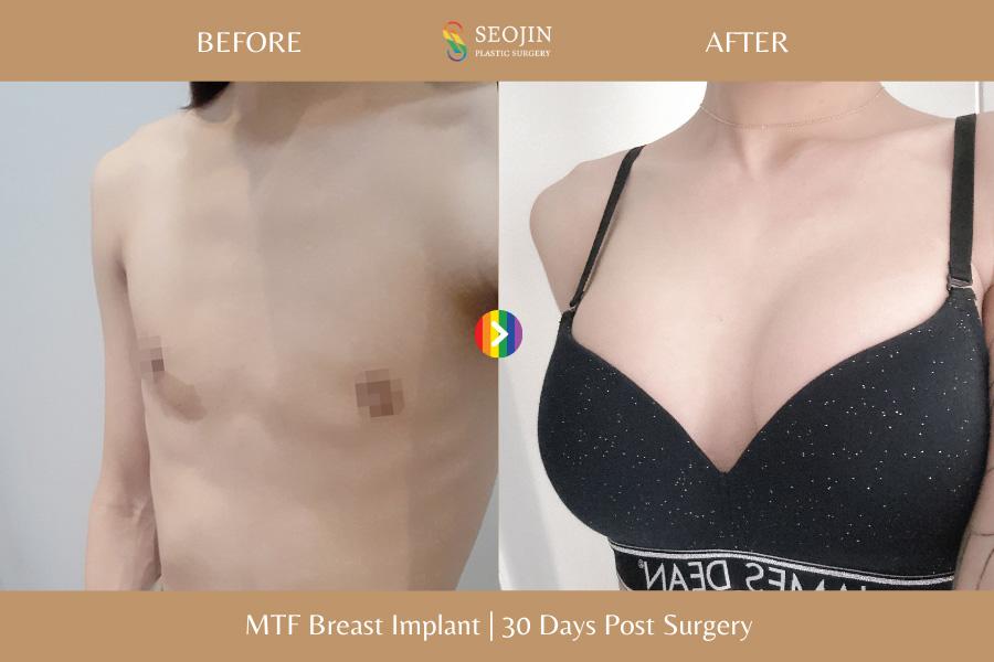 Seojin Plastic Surgery Clinic before and after image