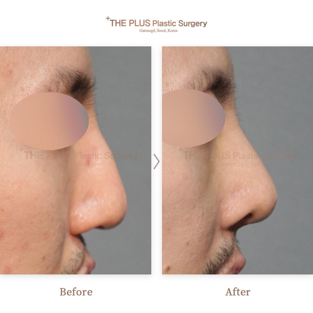 The Plus Cleft Lip Before After