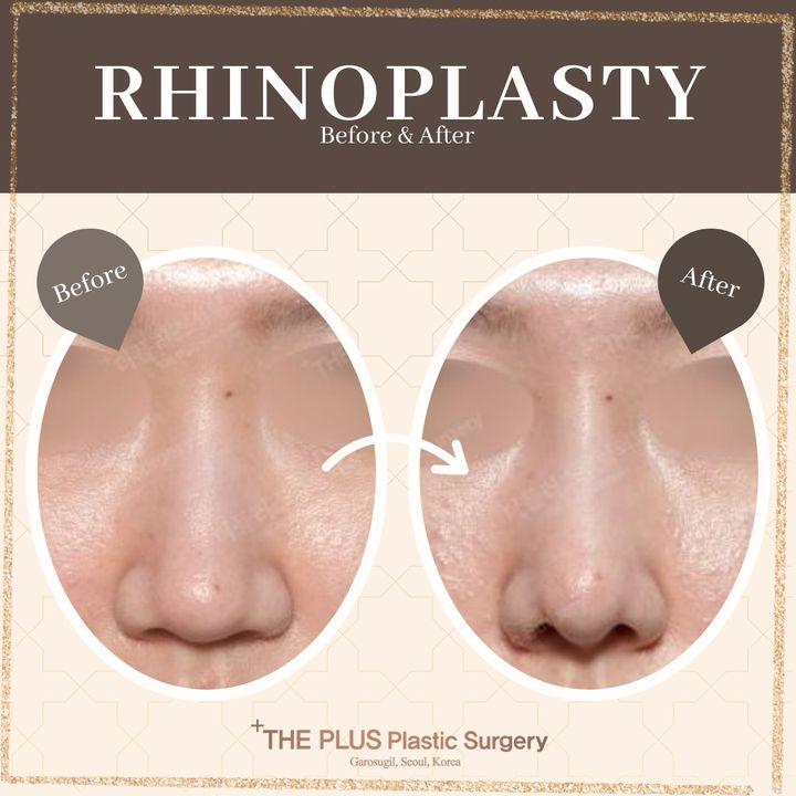 Transformative Elegance: Before & After Rhinoplasty at ThePlus! Witness the remarkable journey as we sculpt and refine noses, harmonizing with individual face shapes. Ready for a nose that complements your unique beauty? Let's unveil your personalized transformation!