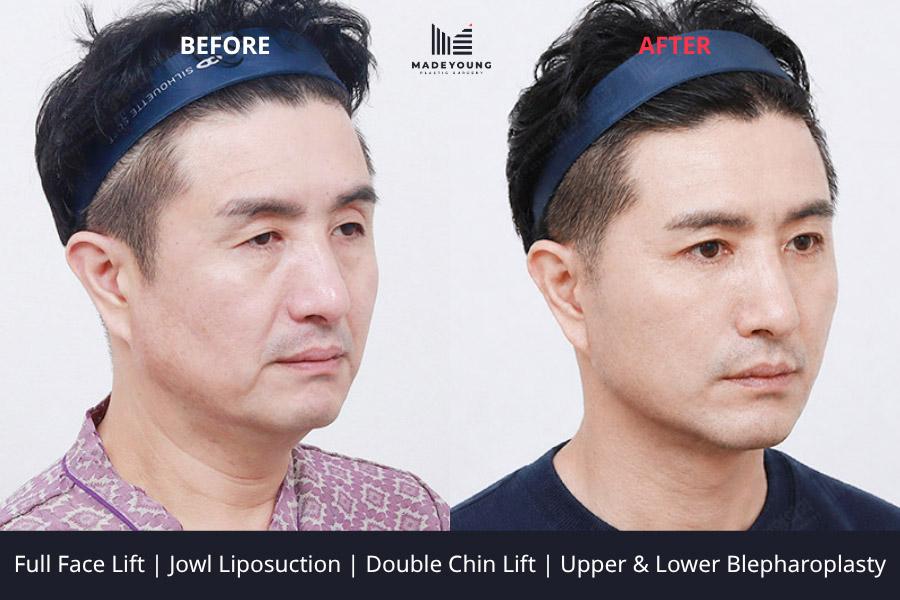 Face lift jowl liposuction double chin lift upper blepharoplasty upper eyelid fat grafting lower blepharoplasty