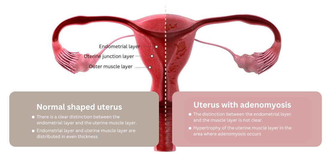 Adenomyosis