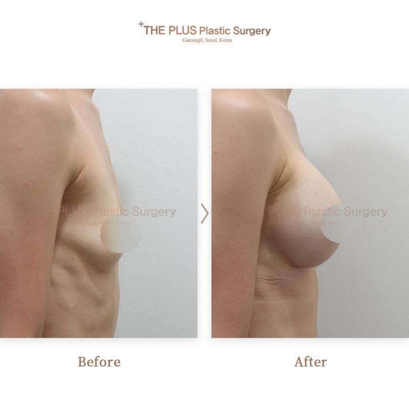 Breast Implant