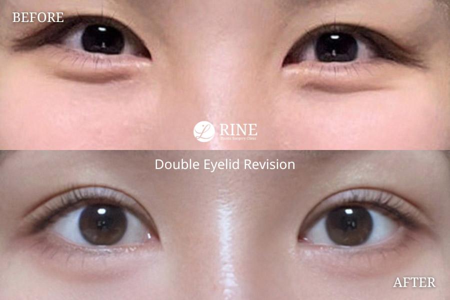 Double Eyelid revision
