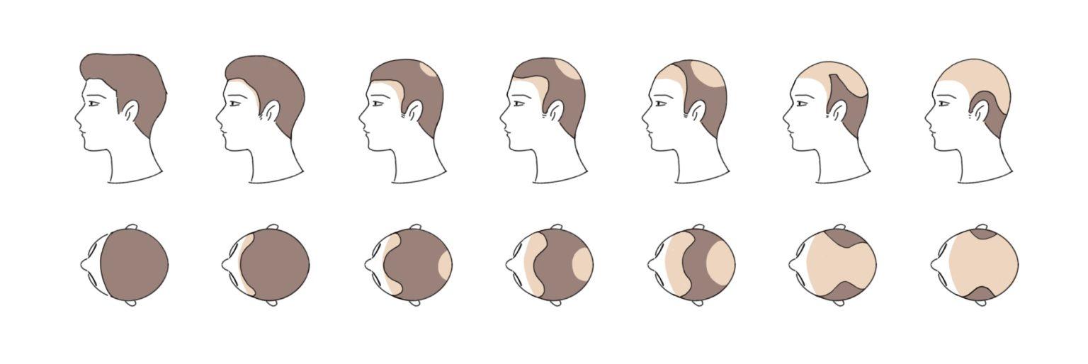 Hairline Correction, Hair Transplant, Hair Loss Treatment
