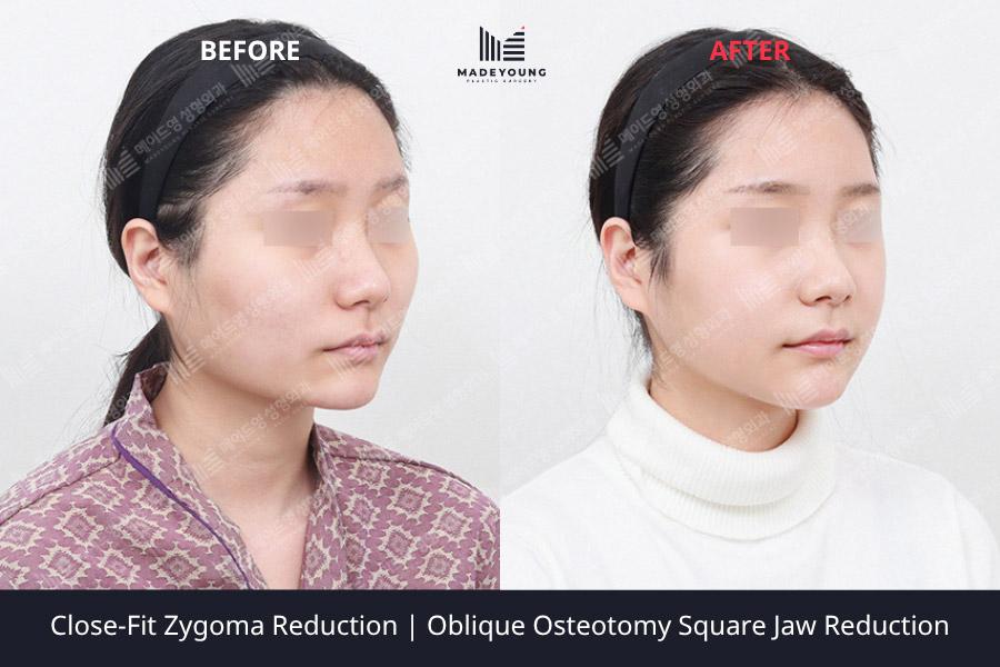 Fit zygoma reduction oblique osteotomy square jaw reduction 1