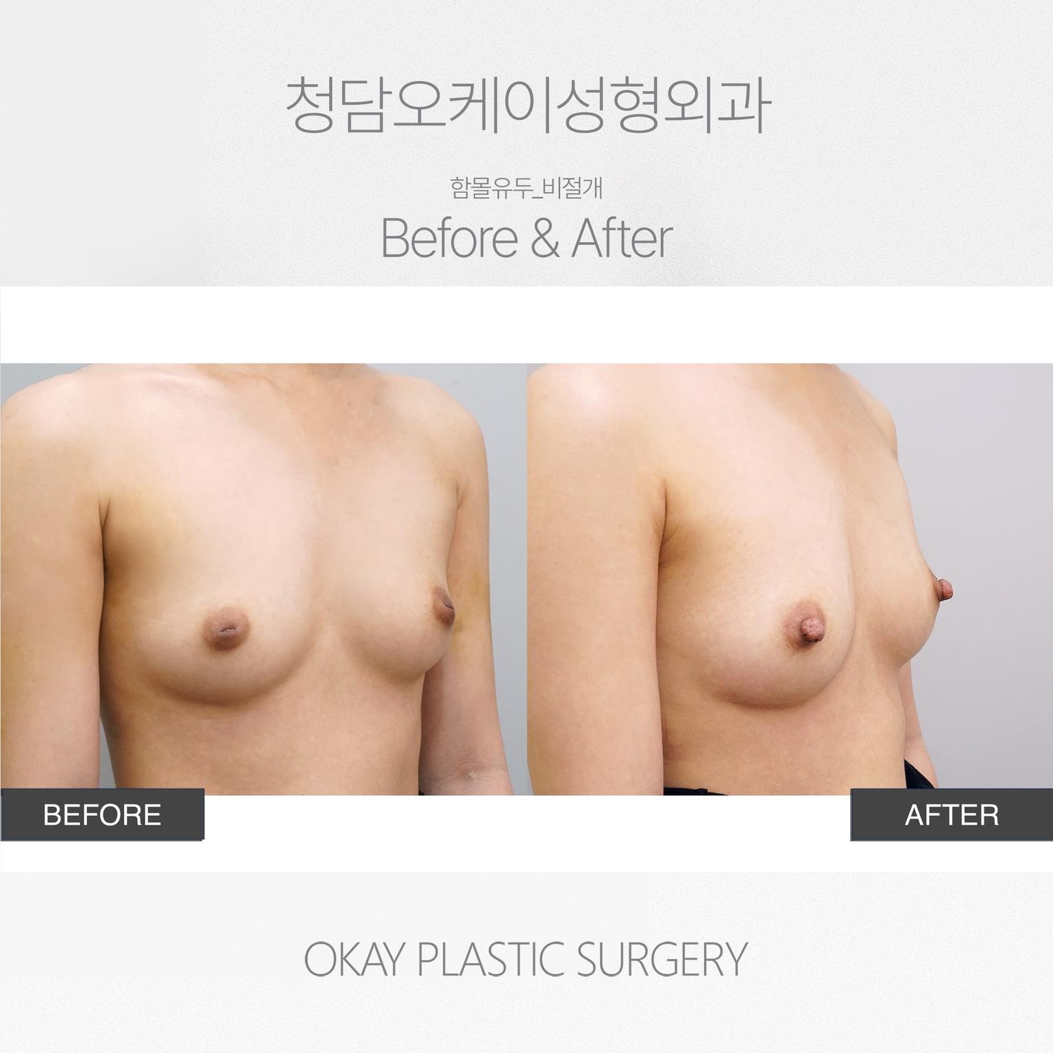 Okay Plastic Surgery Clinic before and after image
