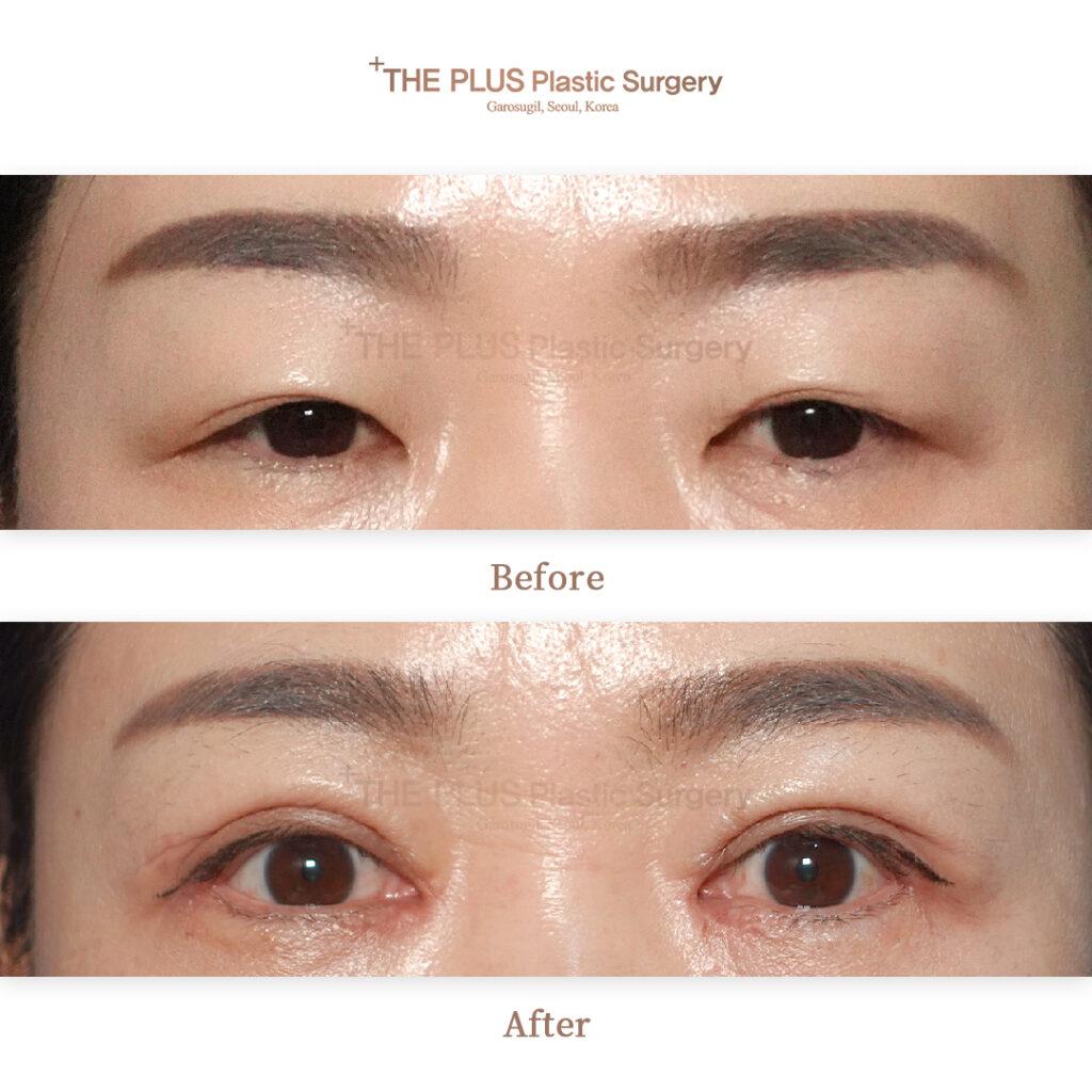 Revision Upper Blepharoplasty & Epicanthoplasty & Lateral Canthoplasty & Lowering of Lower Eyelid