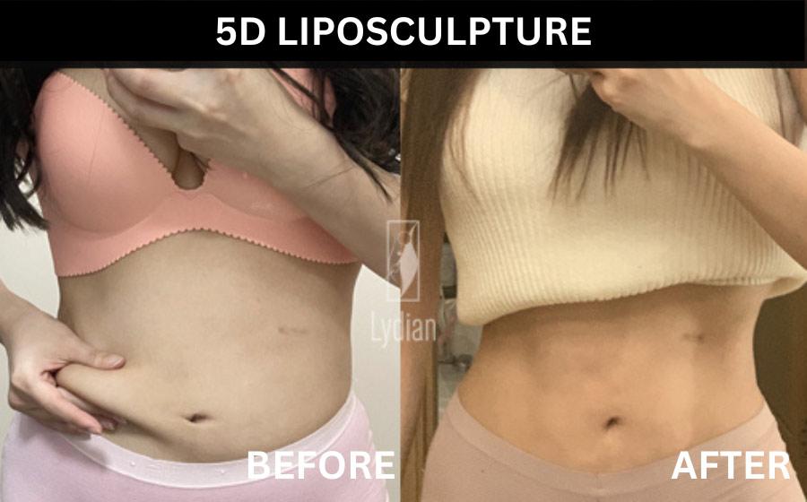 Vorher-Nachher-Bild der Lydian Plastic Surgery Clinic