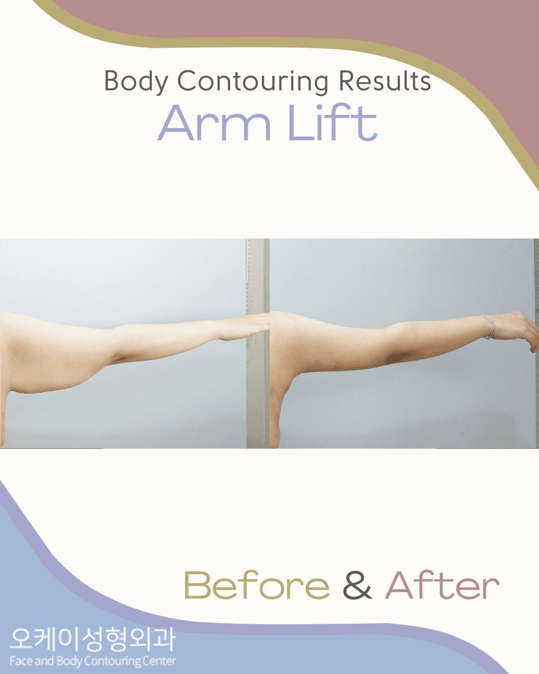 Arm Lift