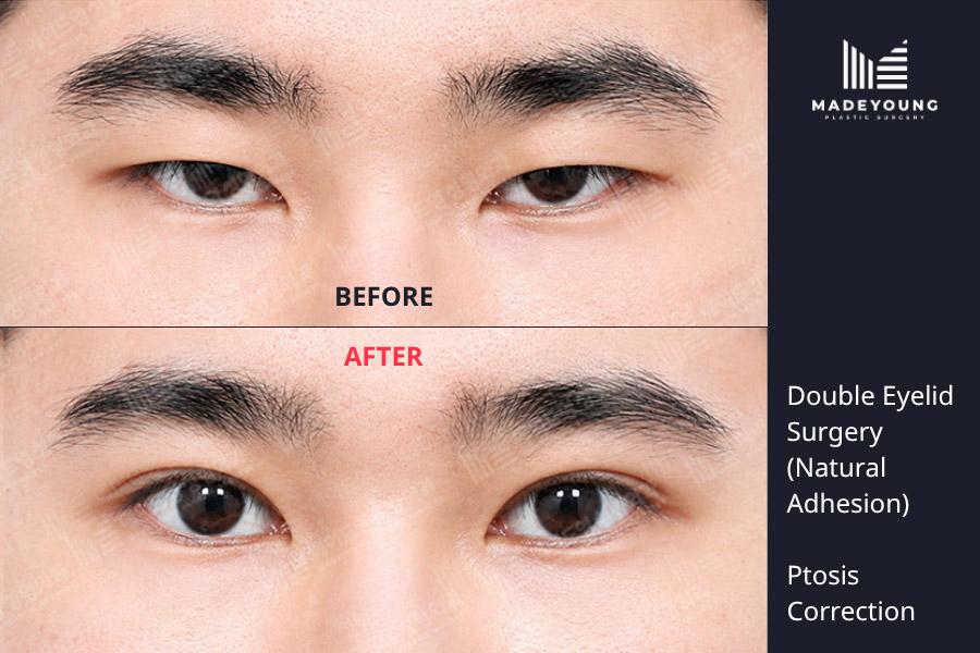 Eyelid surgery natural adhesion ptosis correction