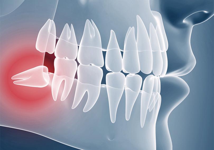Wisdom Tooth Removal