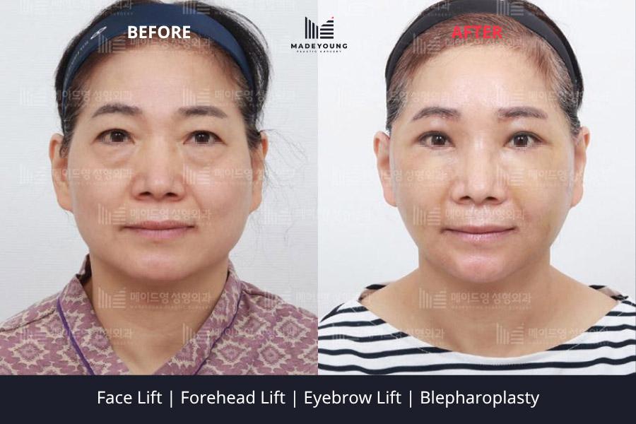 Made Young Plastic Surgery before and after image