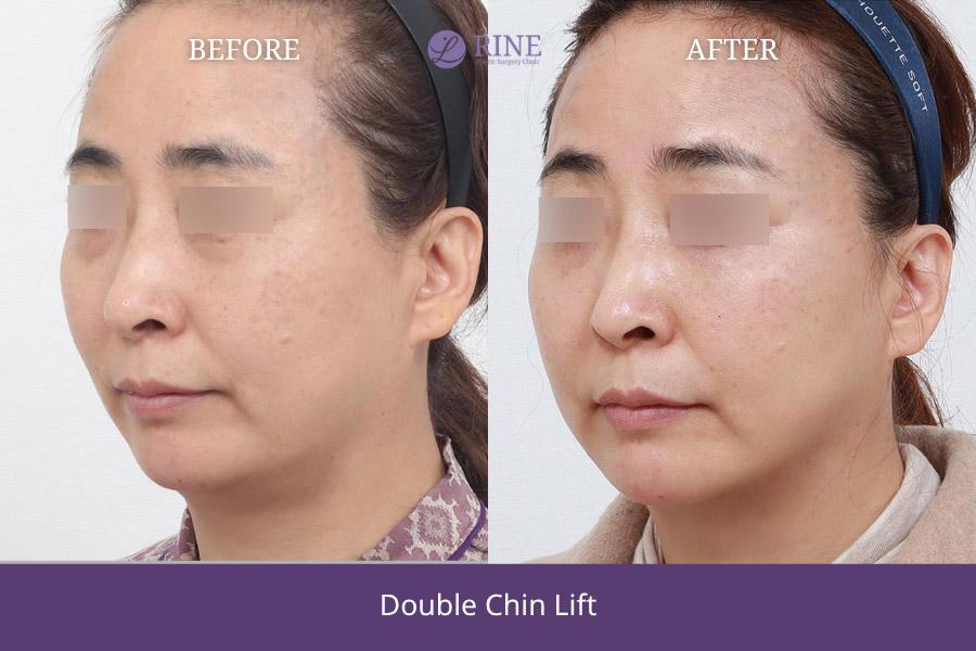 Double Chin lift