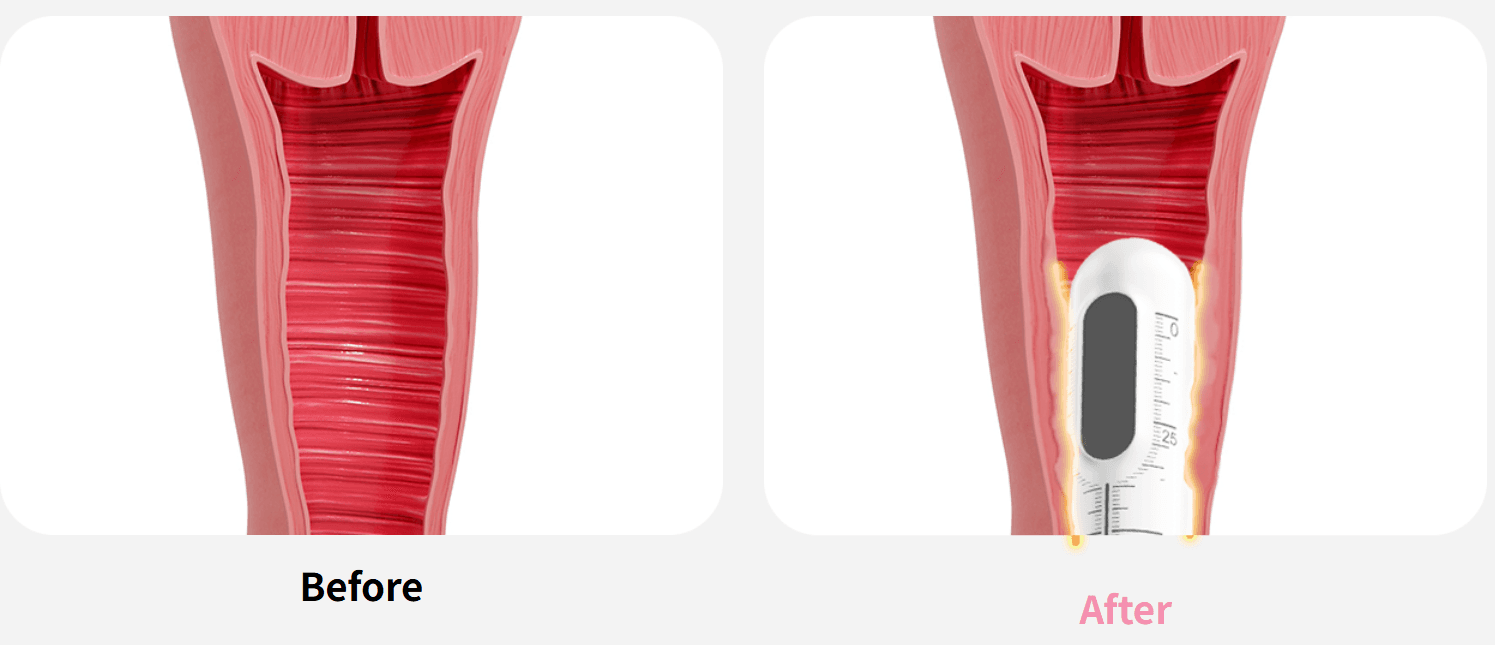 Vaginal Tightening Laser