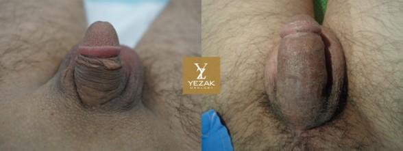 Comprehensive Penile Enhancement at Yezak Penis Enlargement + Penis Lengthening + Glans Enlargement + Premature Ejaculation Treatment + Erectile Dysfunction Treatment