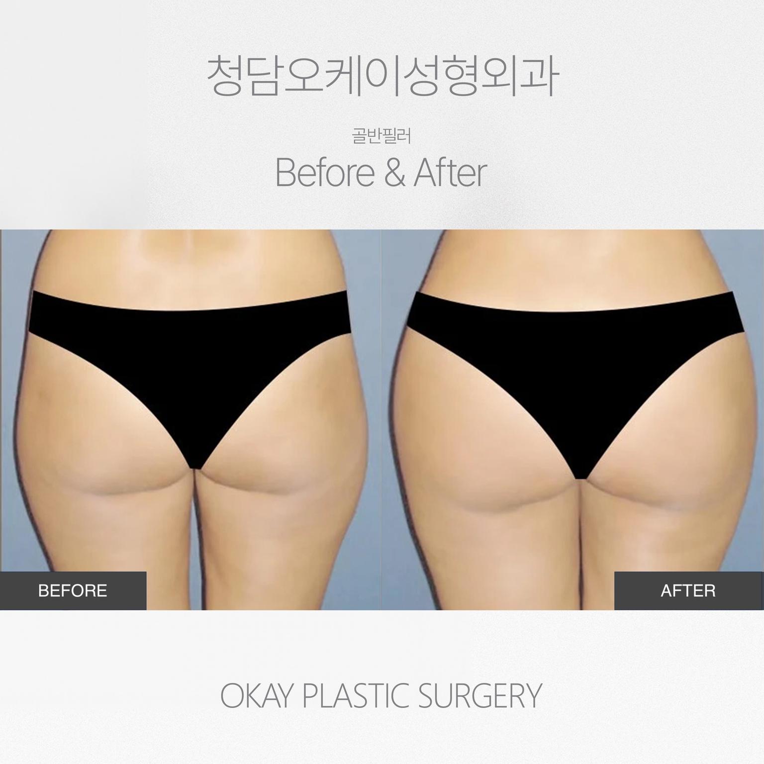Okay Plastic Surgery Clinic before and after image