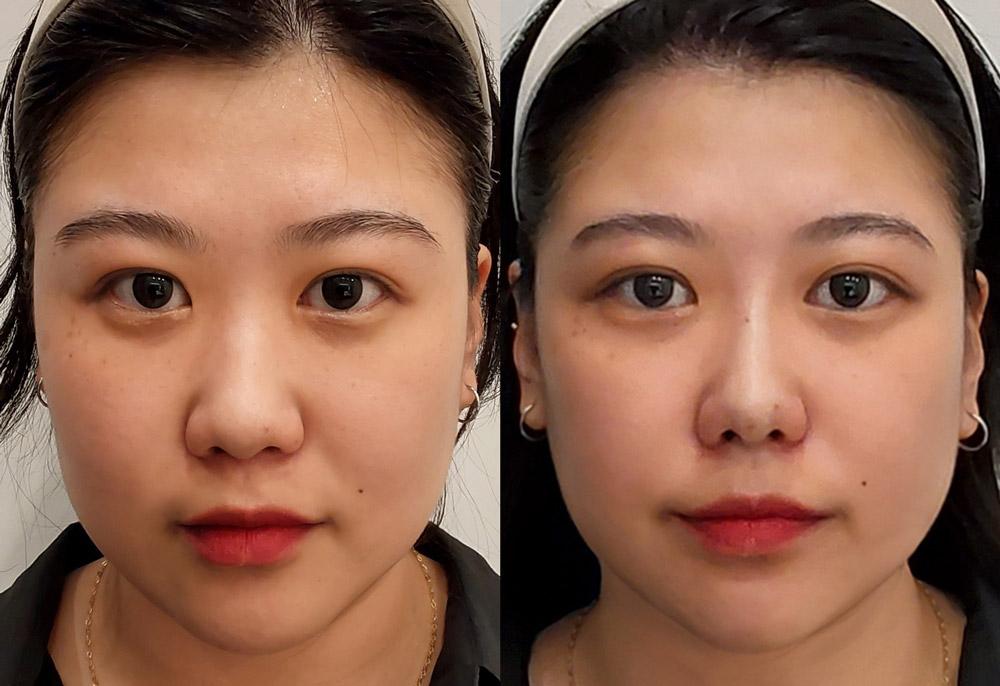 Female nose thread lift