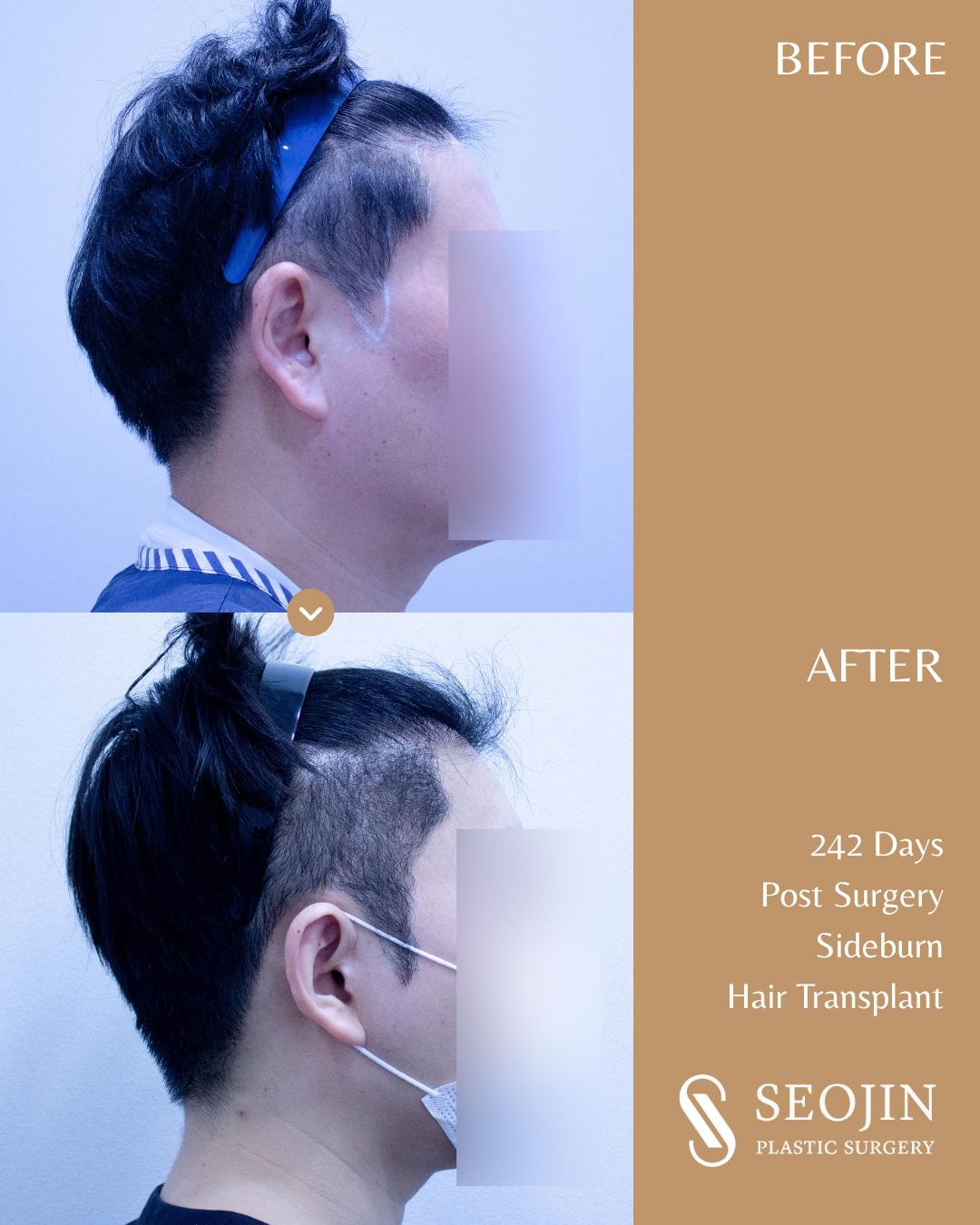 Sideburn Transplant