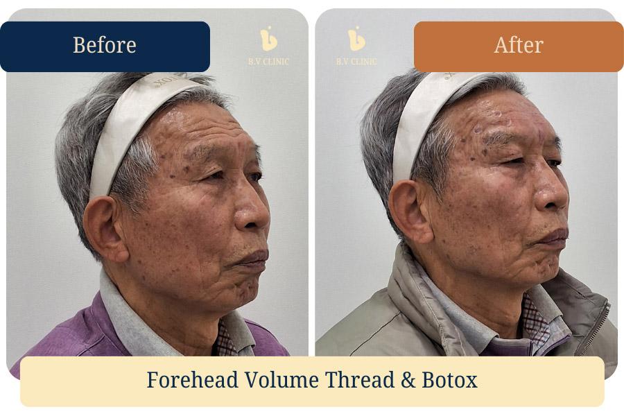 Forehead wrinkle treatment with volume threads and Botox.