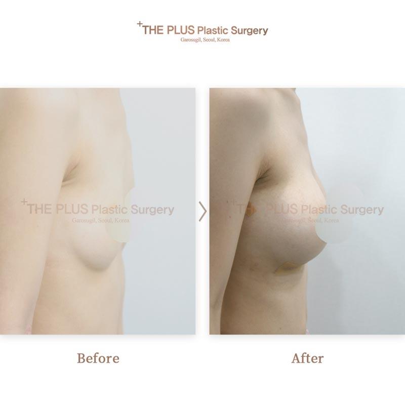 Breast augmentation with autologous fat grafting
