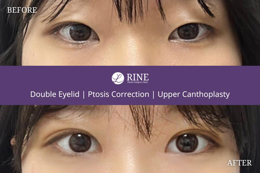 Double Eyelid ptosis correction upper canthoplasty
