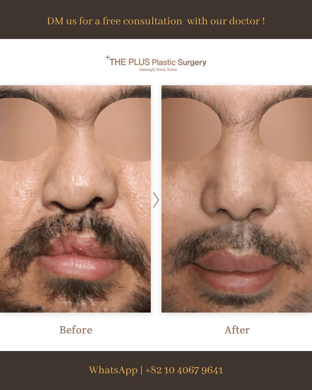 Cleft Lip Surgery, Cleft Rhinoplasty, Cleft Palate Surgery