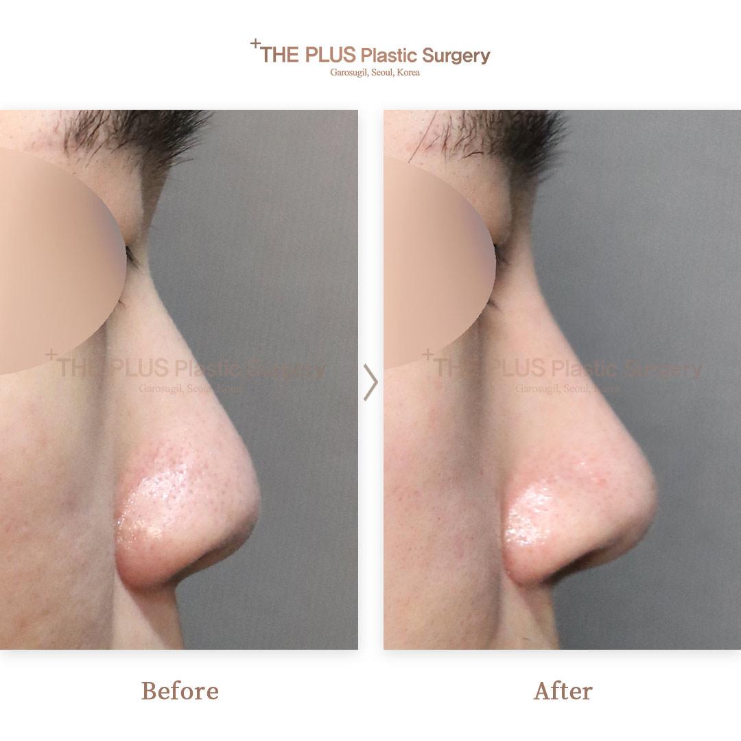 The plus before after nasolabial angle adjustment surgery