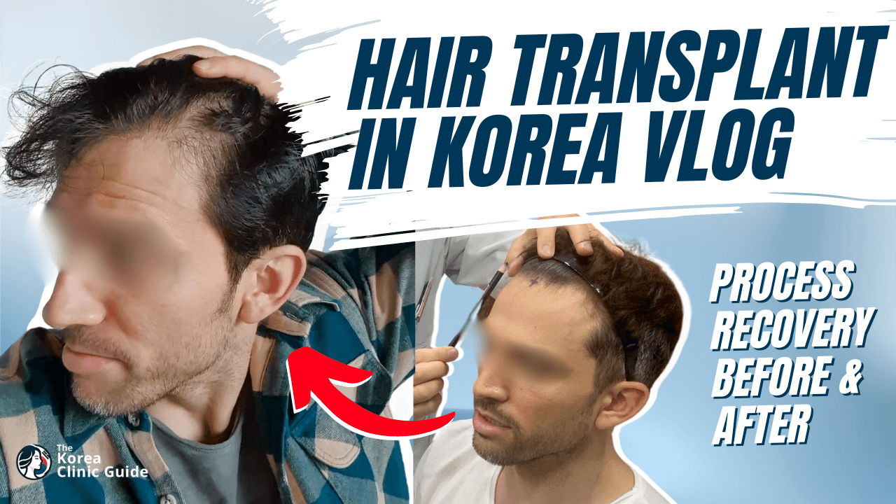 Hair Transplant in Korea Vlog │ Day 1 - 6 Months Recovery Journey at Maxwell Hair Transplant Clinic