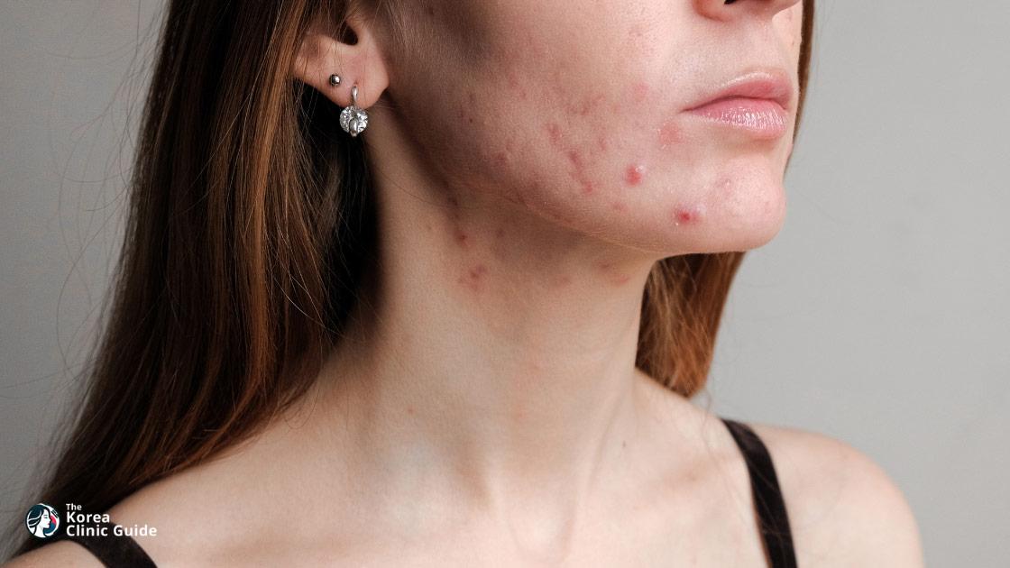 Acne Treatment in Korea: Medical Options, Travel Planning, and Aftercare