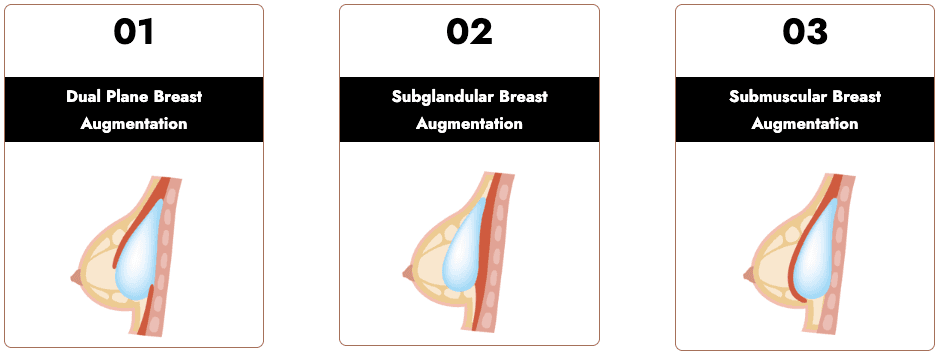 Breast Implant, Breast Augmentation, Breast Surgery