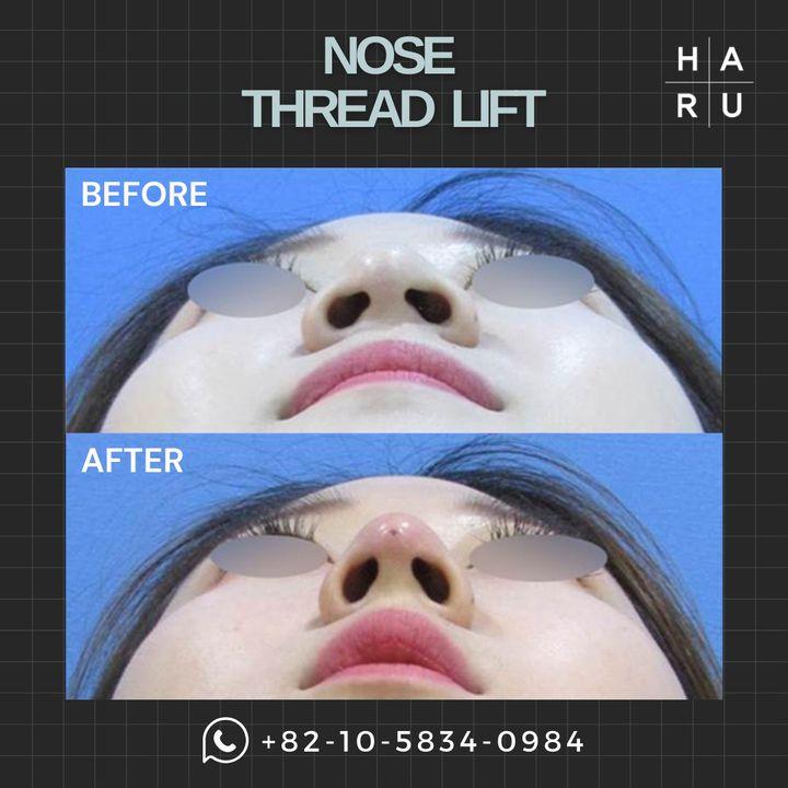 Elevate your profile with our minimally invasive Nose Thread Lift. Witness the subtle yet transformative lift in our before and after photos. Discover how this quick procedure can redefine your natural beauty. 🌈