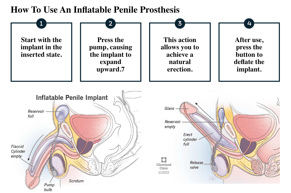 Erectile Dysfunction