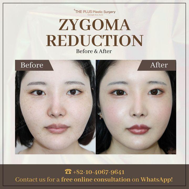 Refine your facial contours with our zygoma reduction surgery. These before and after images showcase the subtle yet impactful changes we can achieve. â–ş