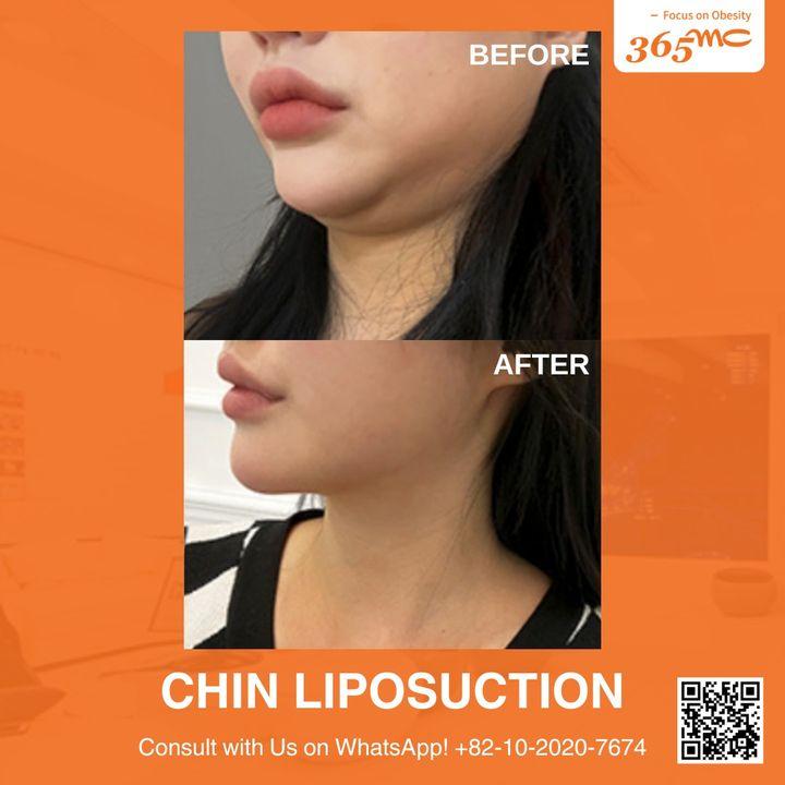 Achieve a more defined jawline with our minimally invasive chin liposuction!