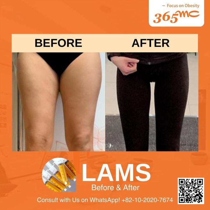 Before and after LAMS: Witness the transformative power of LAMS. Tailored to your unique shape, our technique promises a smoother, more contoured silhouette.