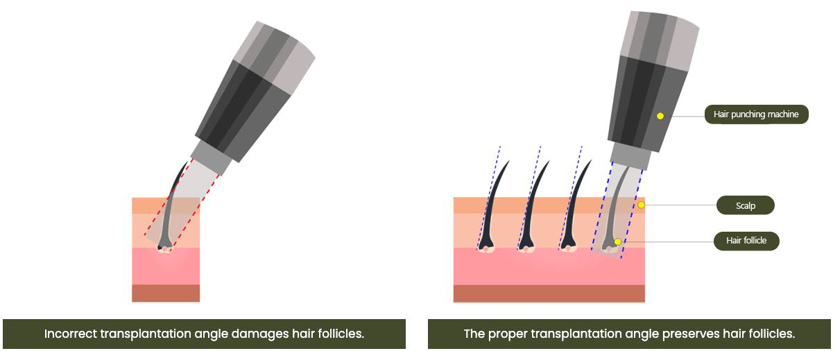 Hair Transplant, Hairline Correction, Hair transplant on Scar