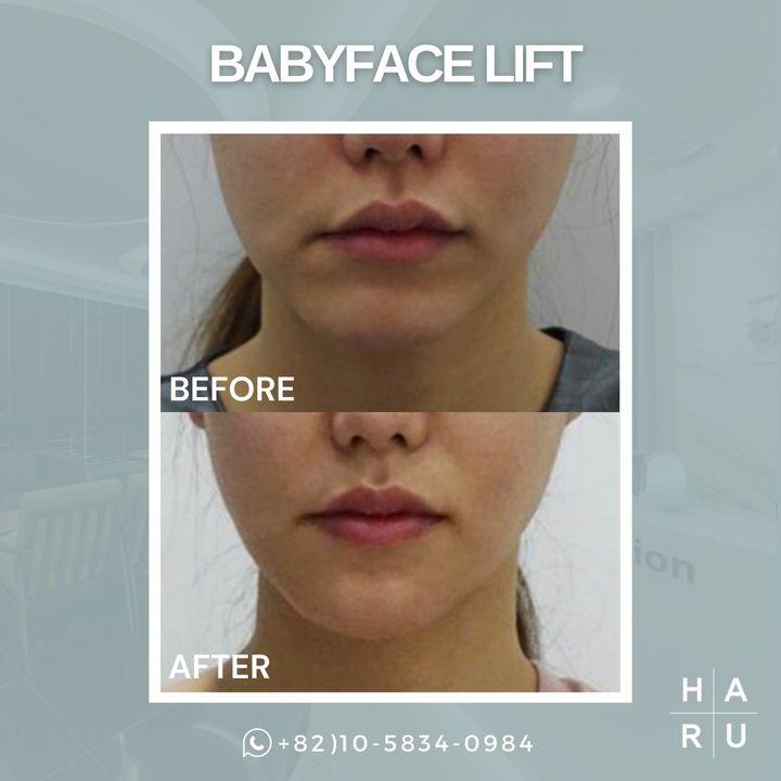 Discover the secret to youthful radiance. Our Babyface Lift offers a rejuvenated look without the need for surgery. Before and after photos speak volumes. 🌈