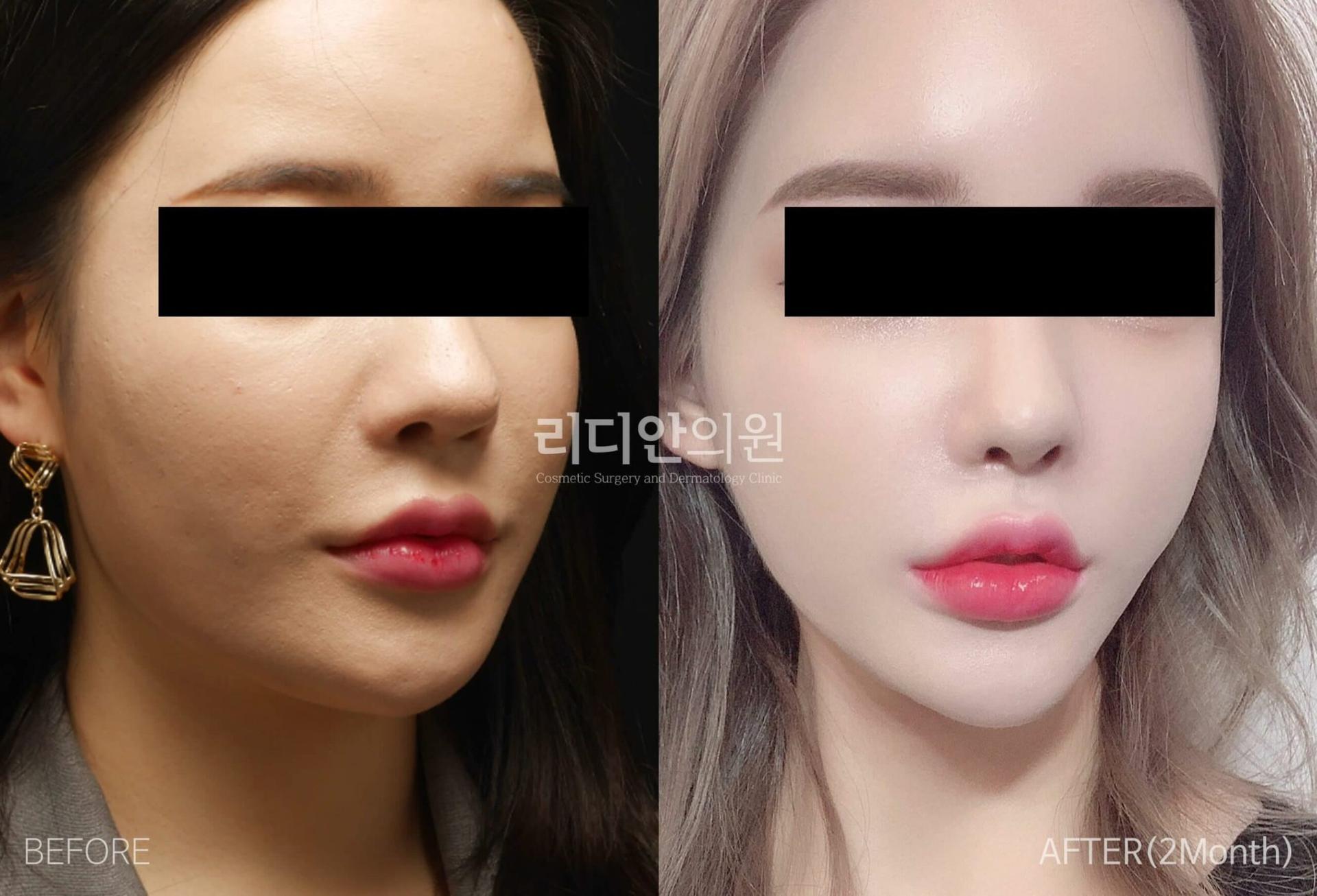 lydian-female-face-liposuction-02.jpg