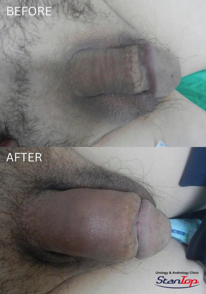 Penis Enlargement