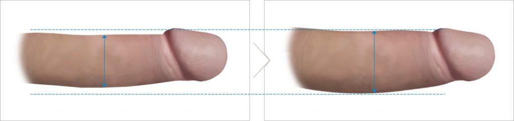 Penis Enlargement