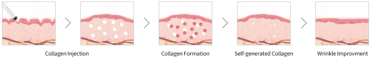 Collagen injection, Collagen Booster