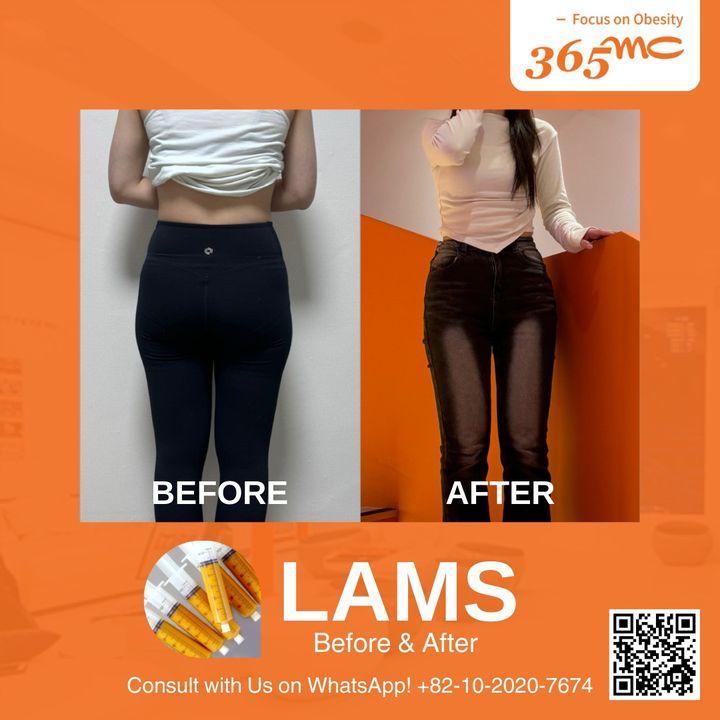 Discover the minimalist approach to maximum results with LAMS. Our before and after showcases demonstrate effective fat reduction with minimal invasiveness.