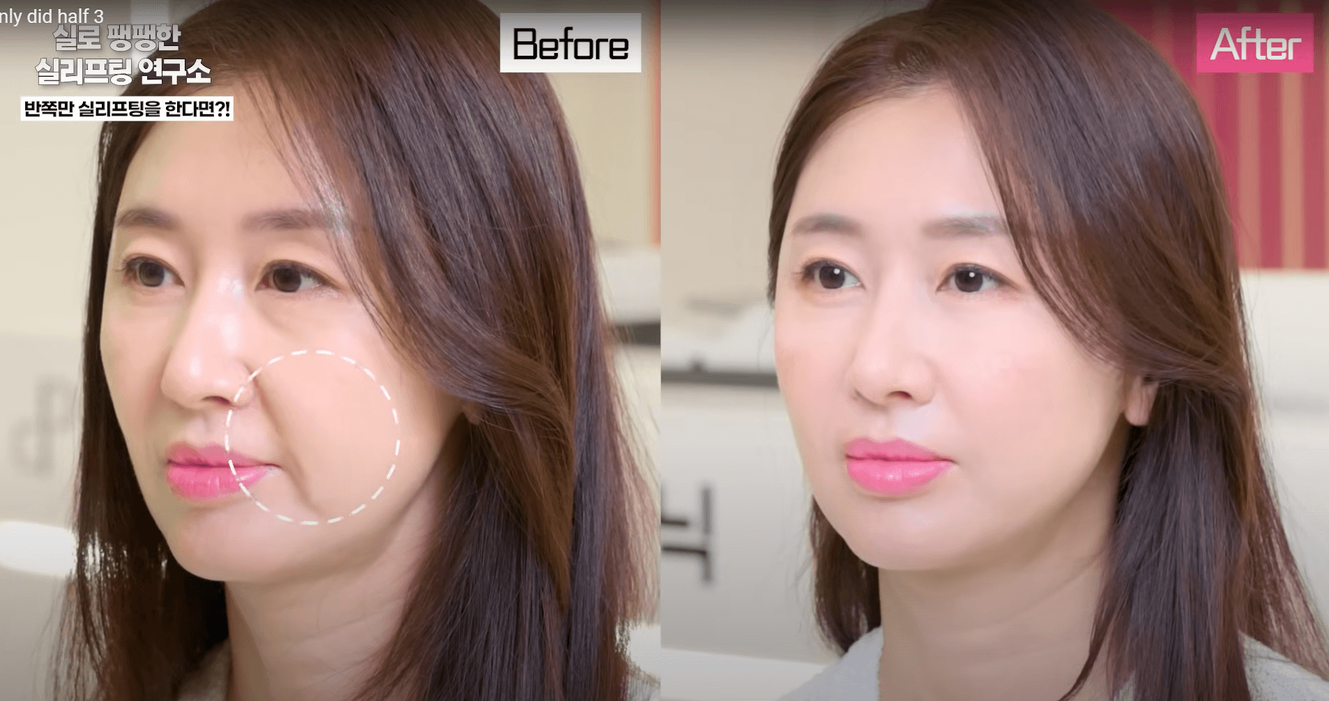 A Personal Review of Getting a Korean Thread Lift & Before After Results