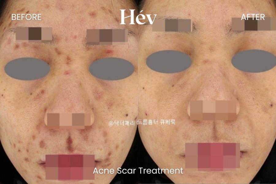 Acne Scar Treatment
