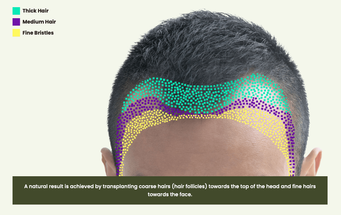 Hairline Correction, Hair Transplant